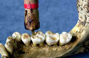 Tools used for proto dentistry